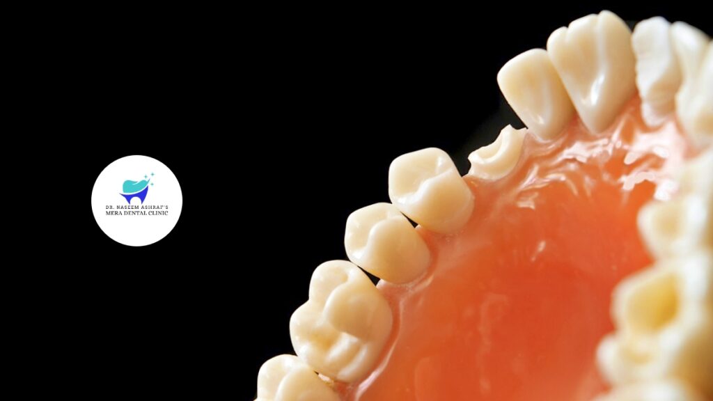 illustration of a dental graft procedure performed at Mera Dental Clinic, showing a dentist carefully placing grafting material in a patient's gum to restore lost bone tissue. The setting is a clean, professional dental office, emphasizing precision and patient care.