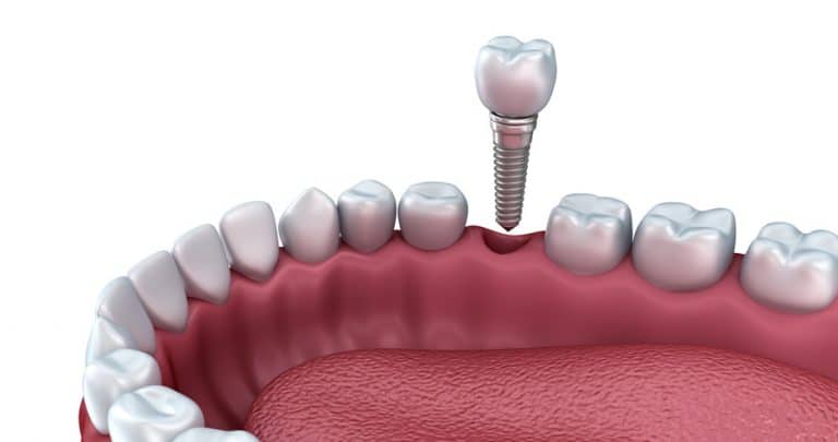 Dental Implant at Mera Dental Clinic